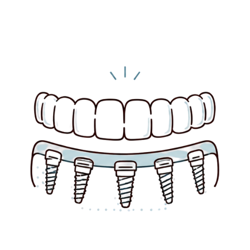 Full Mouth Implants