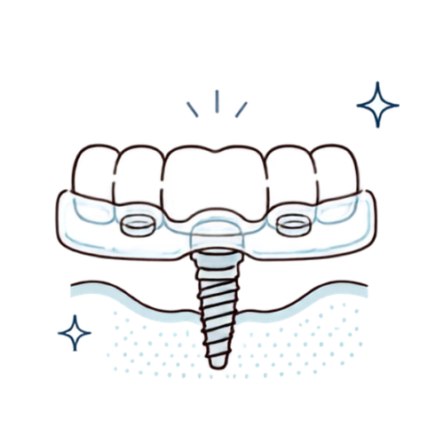 Guided Implant Surgery